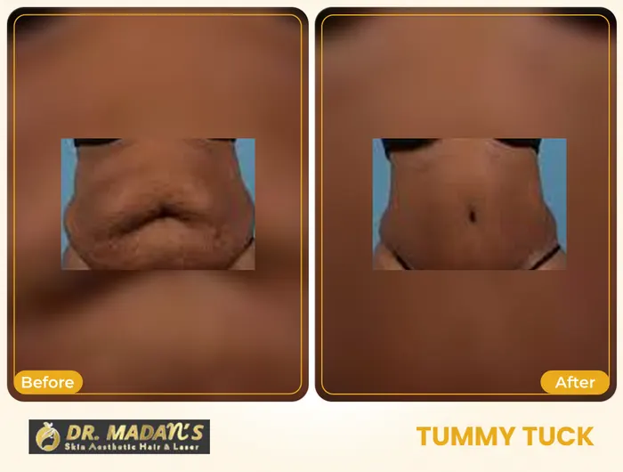 Tummy tuck before and after result 1 at Dr Madan Aesthetics